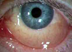 Conjunctivitis