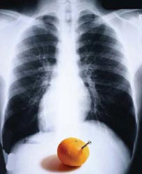 Dyspepsia treatment 