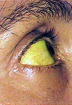 Icterus
