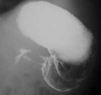 Pylorospasm