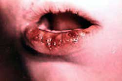Stomatitis